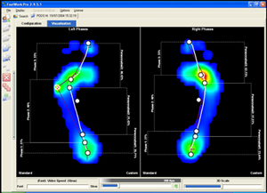 Computerised Gait Analysis CGA Barnet Bishops Stortford East London North London N2