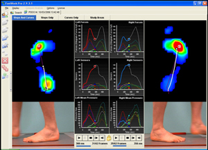Computerised gait analysis East London North London N2 NW11